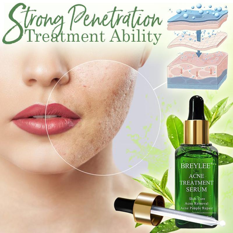 Mascarilla Esmalte facial Breylee ®️ Único en el mercado, elimina machas, acné, espinillas, puntos negros y cierra poros