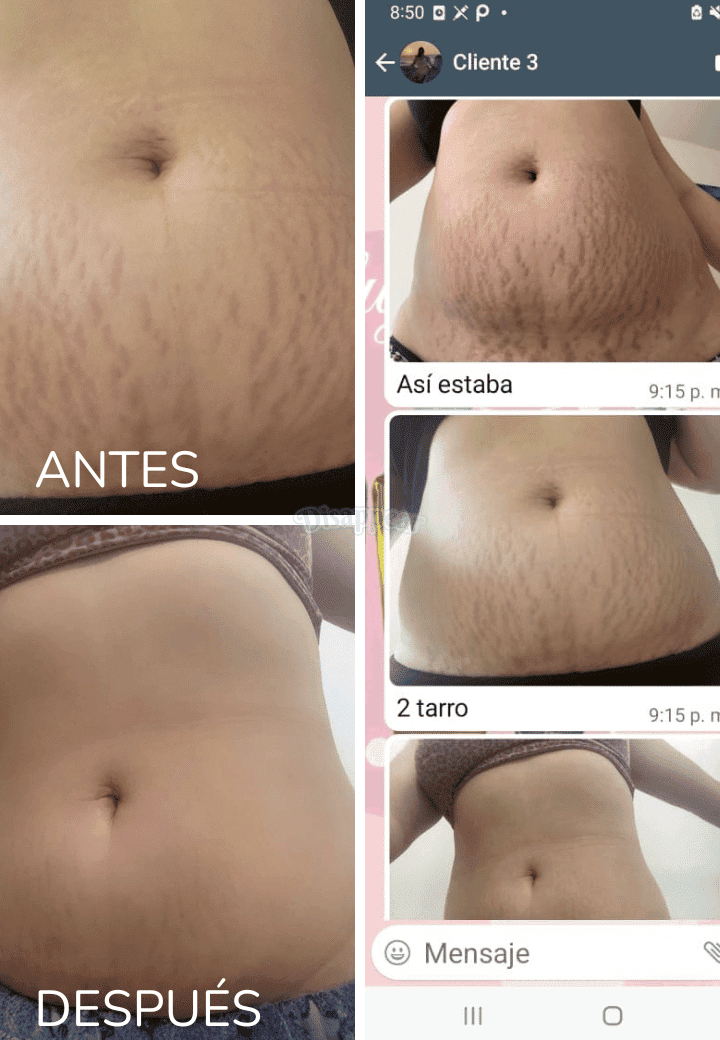 Serum reductor de estrías y celulitis®️ Resultados comprobados y garantizados