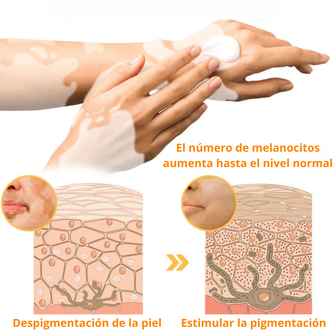 Crema para el tratamiento del vitíligo Fivfivgo™ BeeVenom