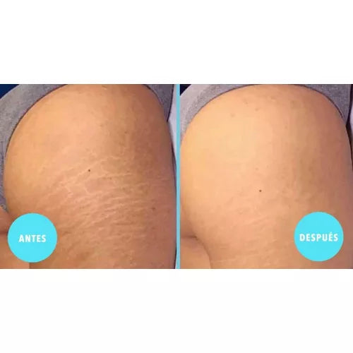 Serum reductor de estrías y celulitis®️ Resultados comprobados y garantizados