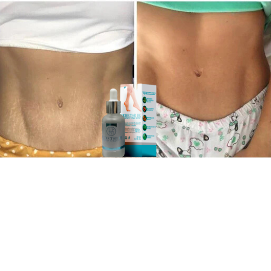 Serum reductor de estrías y celulitis®️ Resultados comprobados y garantizados