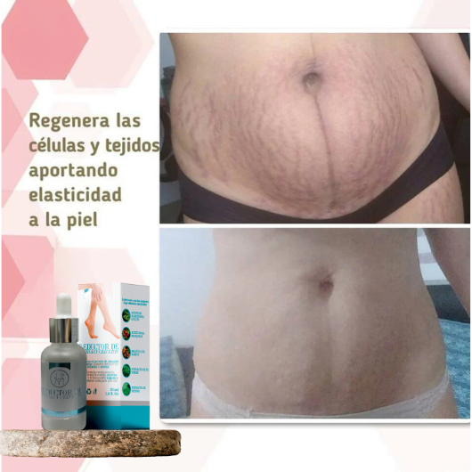 Serum reductor de estrías y celulitis®️ Resultados comprobados y garantizados